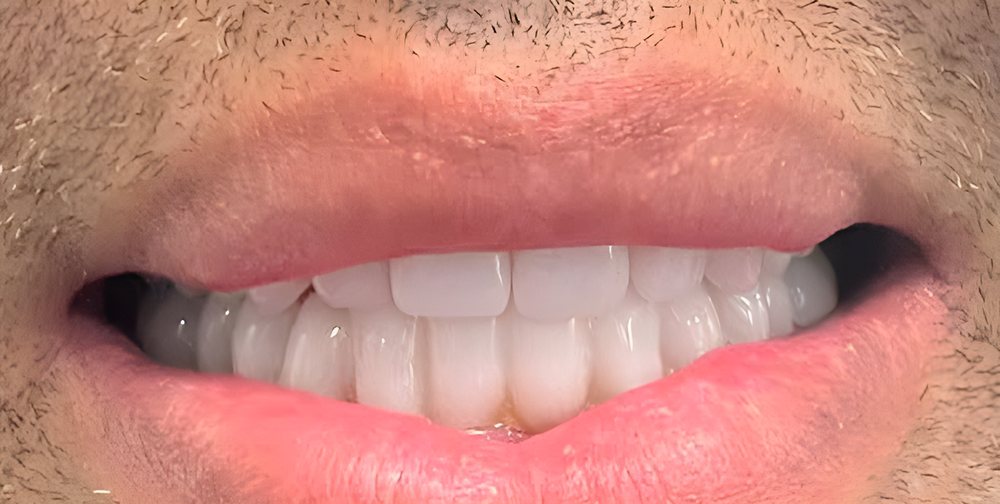 Sonrisa con carillas dentales