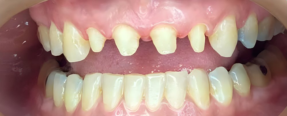 Dientes preparados antes de colocar coronas de zirconia