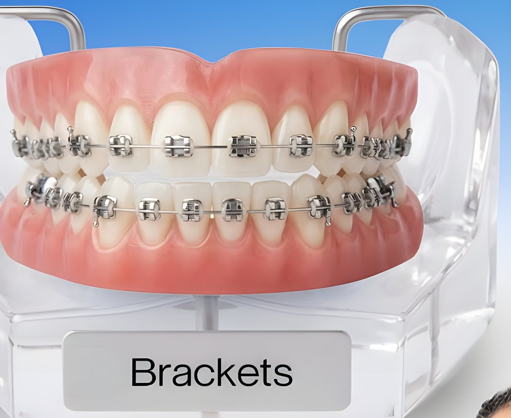 Modelo dental con brackets metálicos